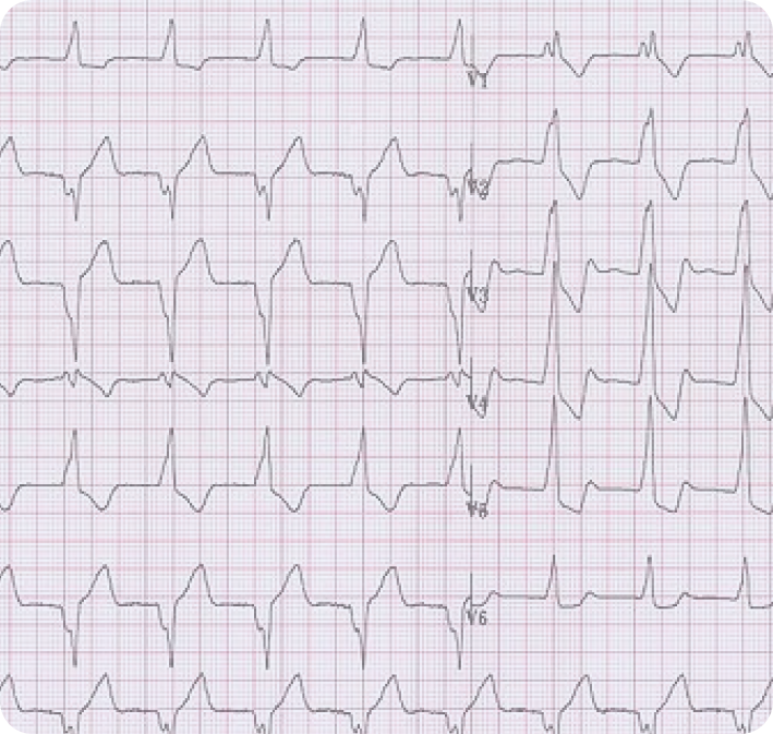 AFIB Insight LP